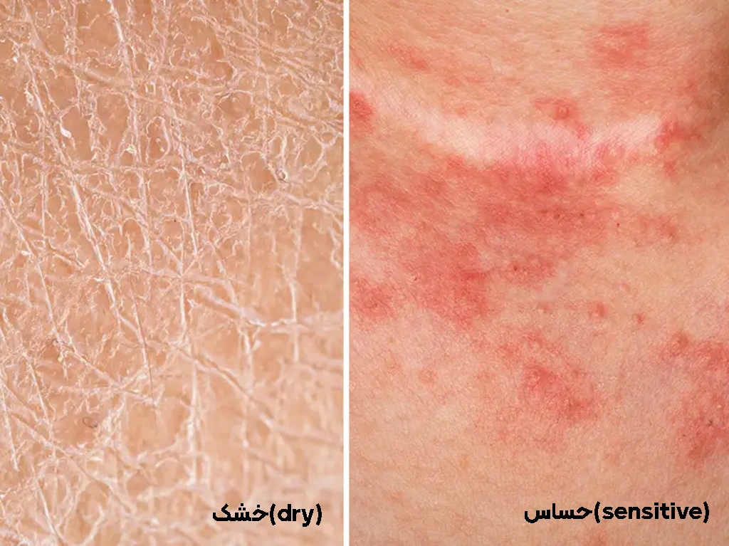 تفاوت پوست خشک وحساس