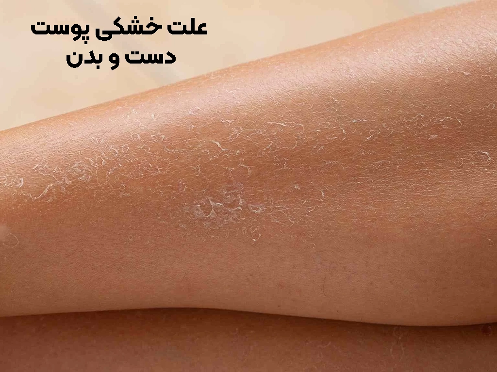 علت های خشکی پوست بدن و دست