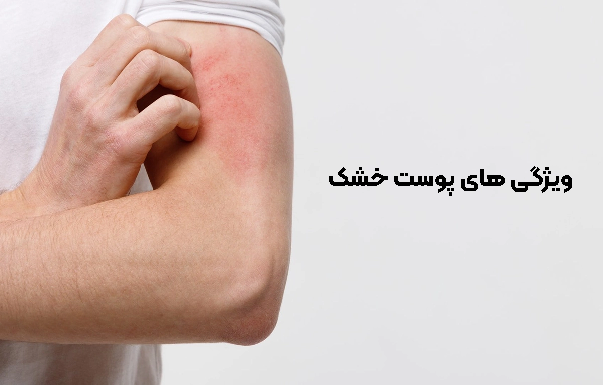 ویژگی های پوست خشک