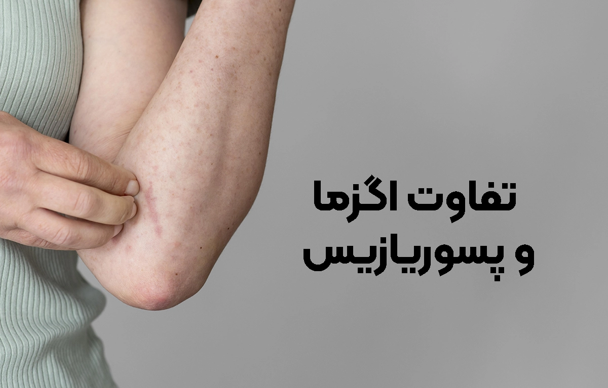 تفاوت اصلی اگزما و پس.ریازیس