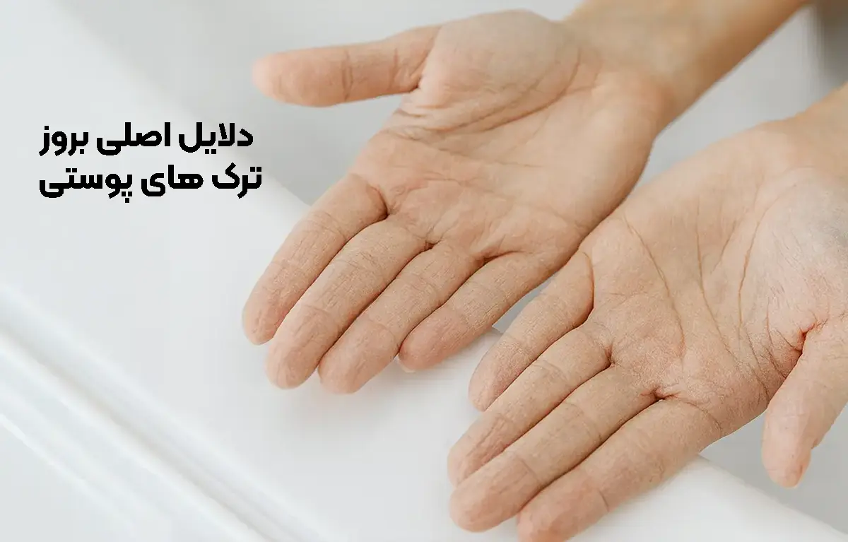 علت های اصلی ایجاد ترک پوستی