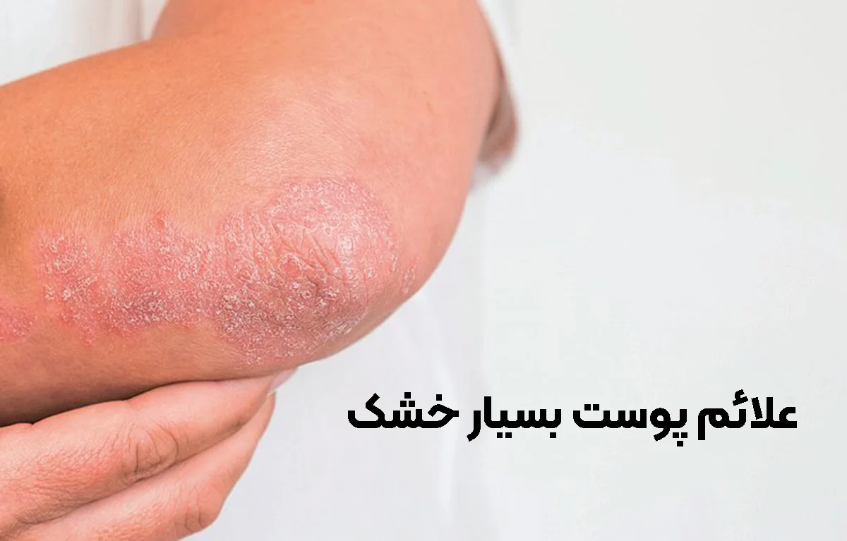 علائم پوست خشک