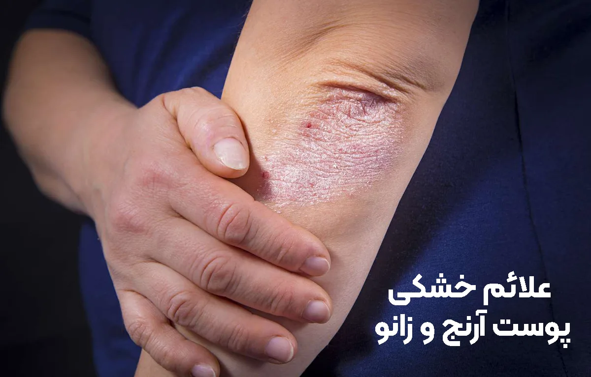 علائم خشکی پوست آرنج و زانو