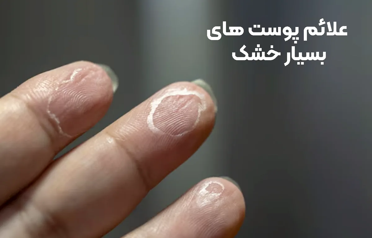 علائم پوست های بسیار خشک