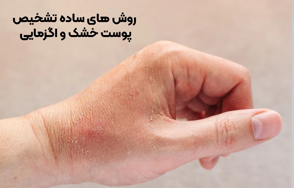 روش‌ های ساده تشخیص پوست خشک و اگزمایی