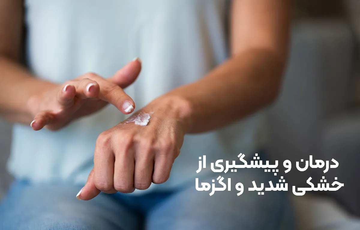 درمان و پیشگیری از خشکی شدید و اگزما