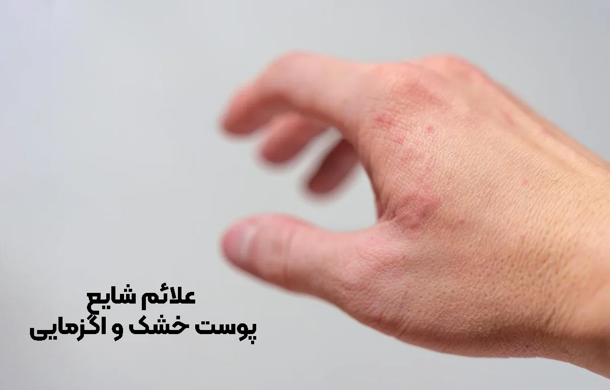 علائم شایع پوست خشک و اگزمایی