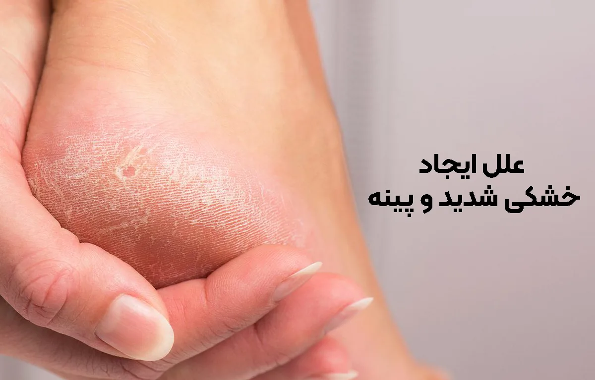 علل ایجاد خشکی شدید و پینه