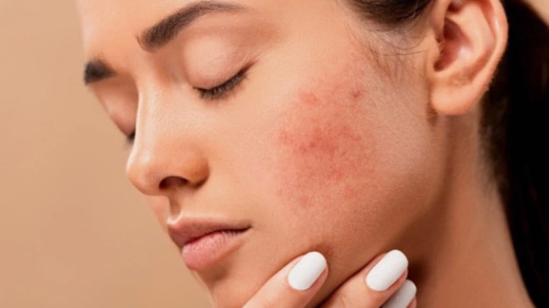 چگونه پوست خشک و حساس را با محصولات مناسب تسکین دهیم؟