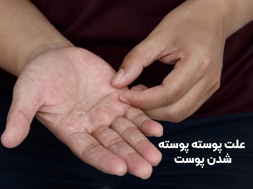 علت پوسته پوسته شدن پوست دست و بدن