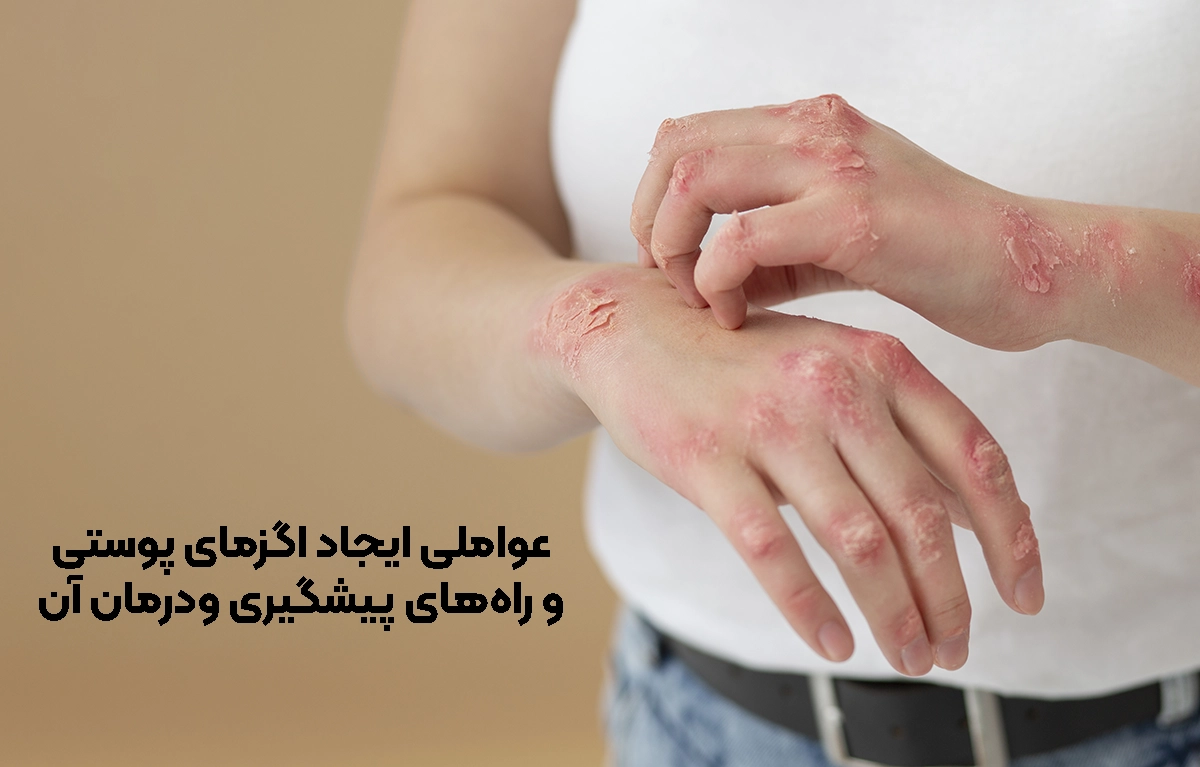 چه عواملی باعث اگزمای پوستی می‌شوند و راه‌های پیشگیری ودرمان آن چیست؟