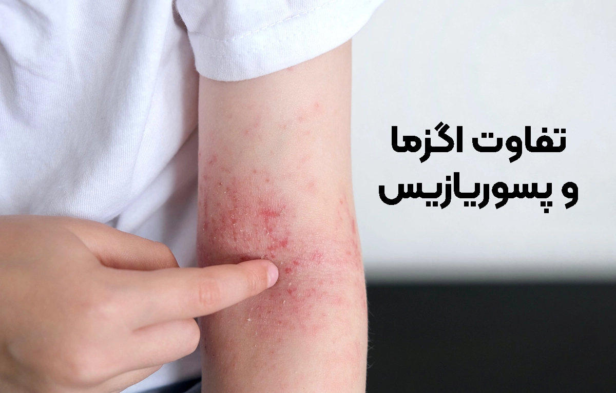 تفاوت اگزما و پسوریازیس