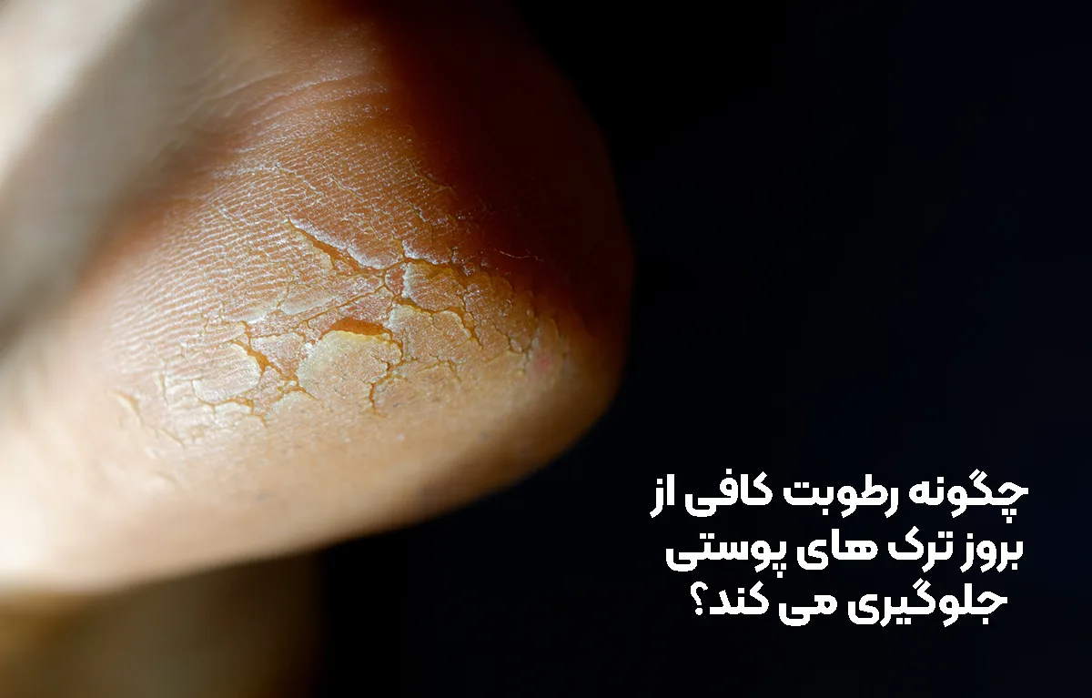 جلوگیری از بروز ترک های پوستی با حفظ رطوبت پوست
