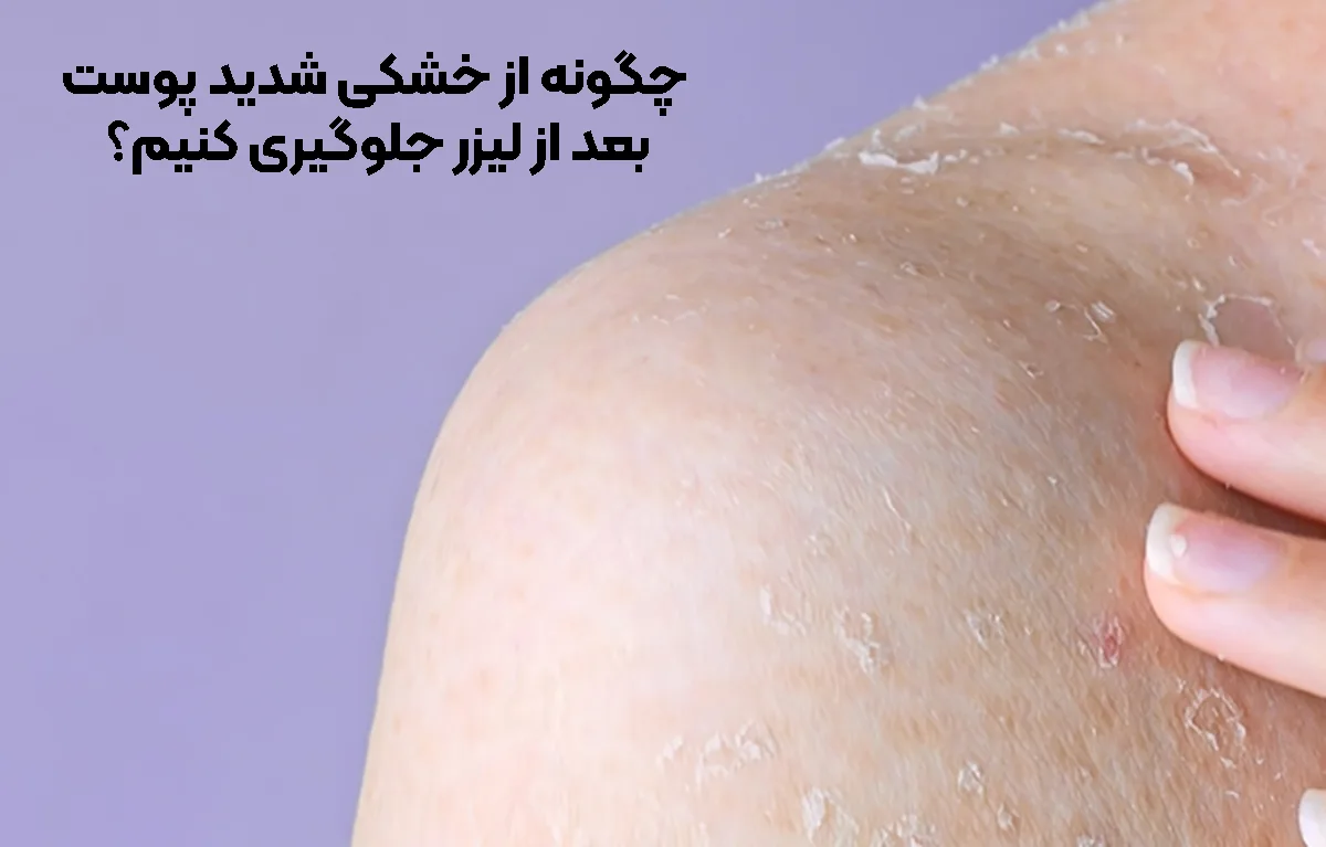 Preventing dry skin after laser treatment