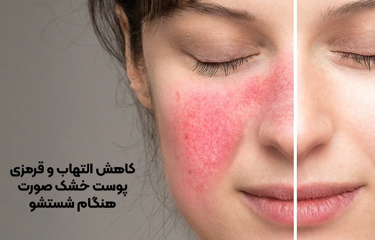 کاهش التهاب و قرمزی پوست‌ خشک صورت هنگام شستشو