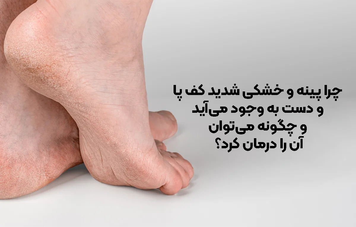 چرا پینه و خشکی شدید کف پا و دست ایجاد می ‌شود و چگونه درمان می ‌شود؟