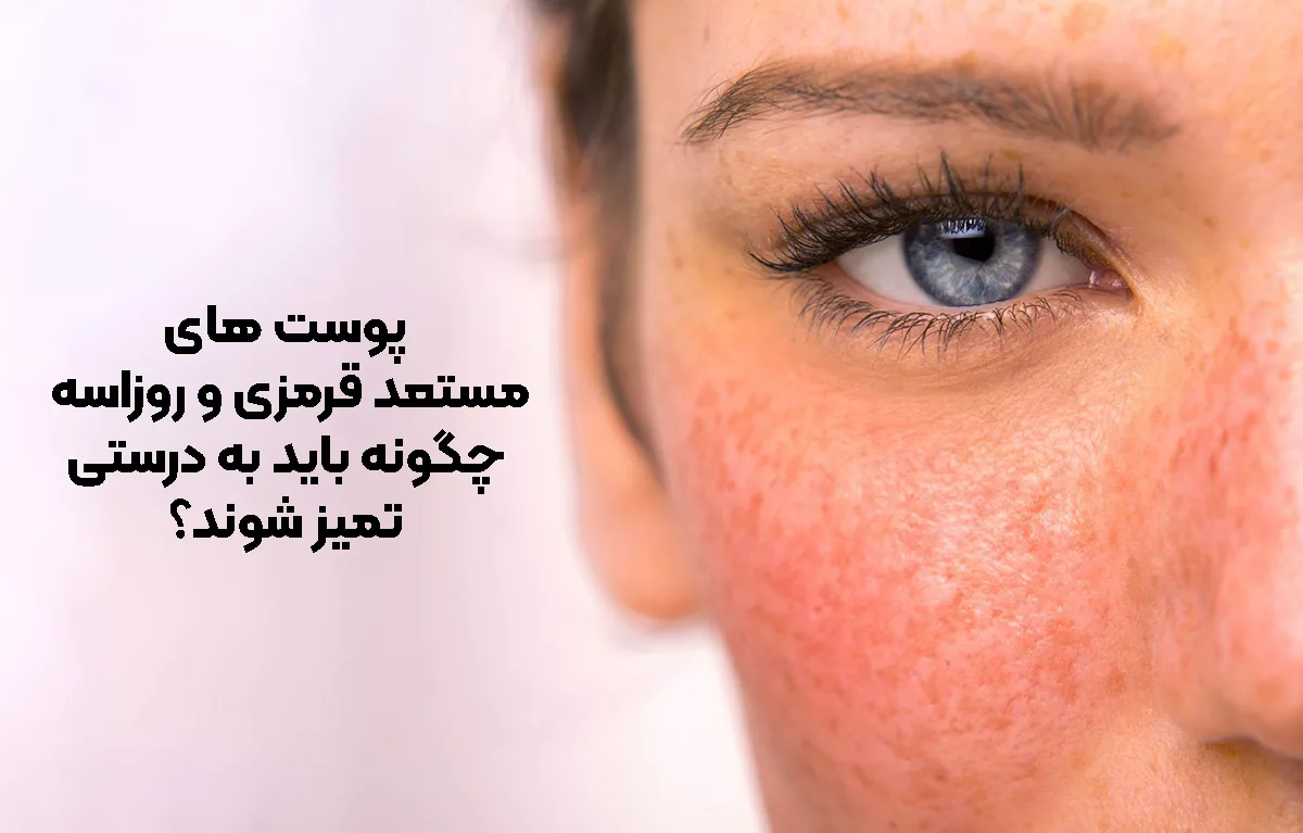 شست و شوی پوست مستعد قرمزی و روزاسه